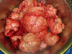 fibroids