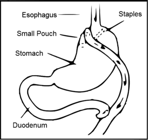 Diagram of a Roux-en-Y gastric bypass.