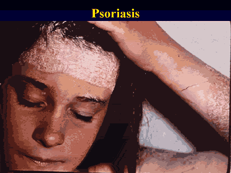 Psoraisis