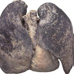 Smoker's Lungs