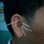 Ear Acupuncture