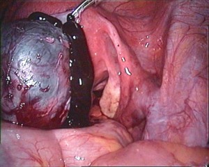 Endometriosis with chocolate cyst