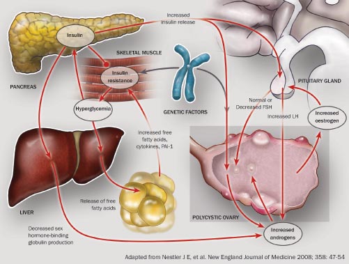 PCOS and Insulin Resistance